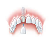 Das eingesetzte Implantat mit der neuen Zahnkrone