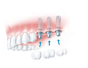 Drei Einzelzähne auf drei Implantaten